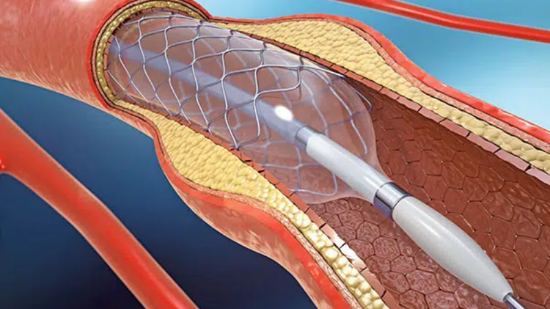 endoskopik stent uygulamaları