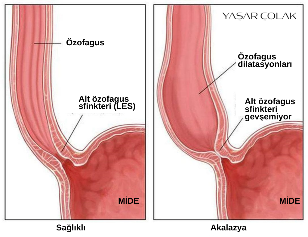 akalazya hastalığı