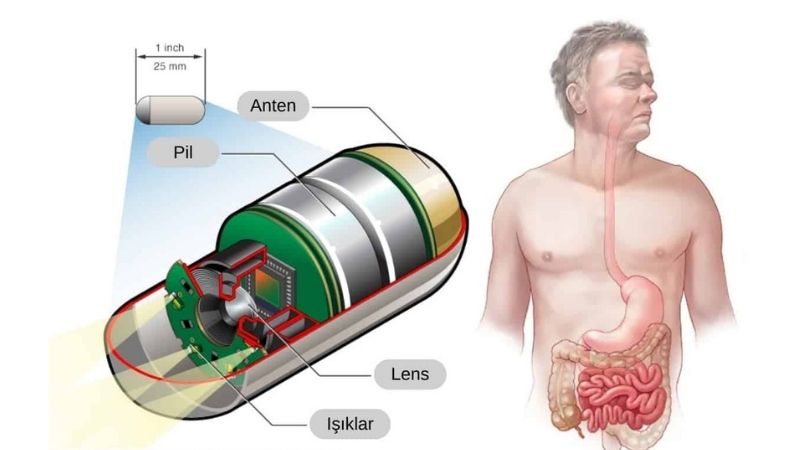 Kapsül Endoskopi