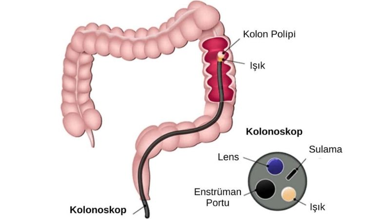 Kolonoskopi