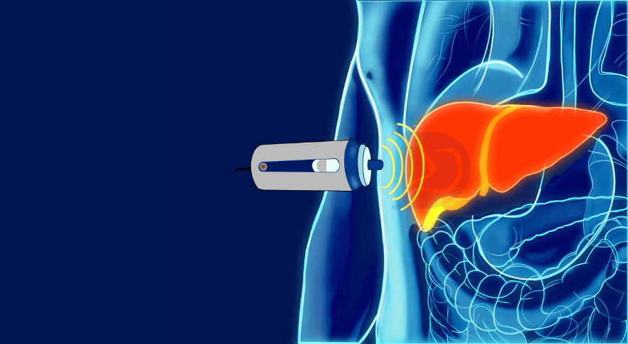 FibroScan Nedir? Uygulama Alanları ve Avantajları Nelerdir?