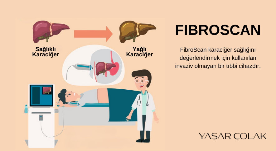 fibroscan