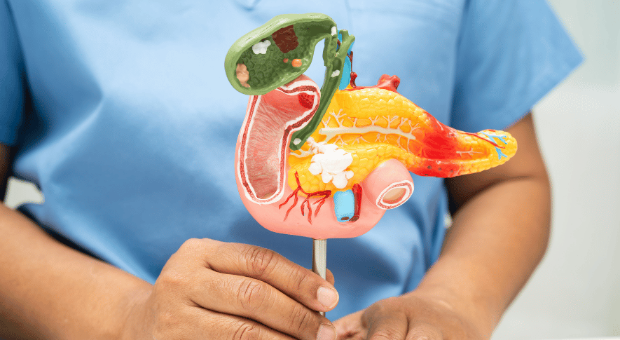 Pankreas Kisti: Belirtiler, Nedenleri, Tedavi Yaklaşımı