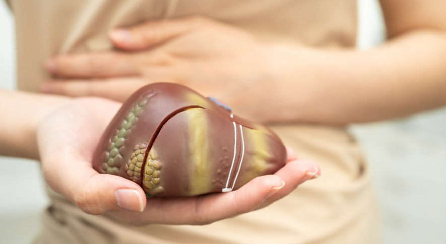 Karaciğer Yağlanması Nedir? Neden Olur ve Nasıl Tedavi Edilir?